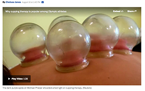 cupping